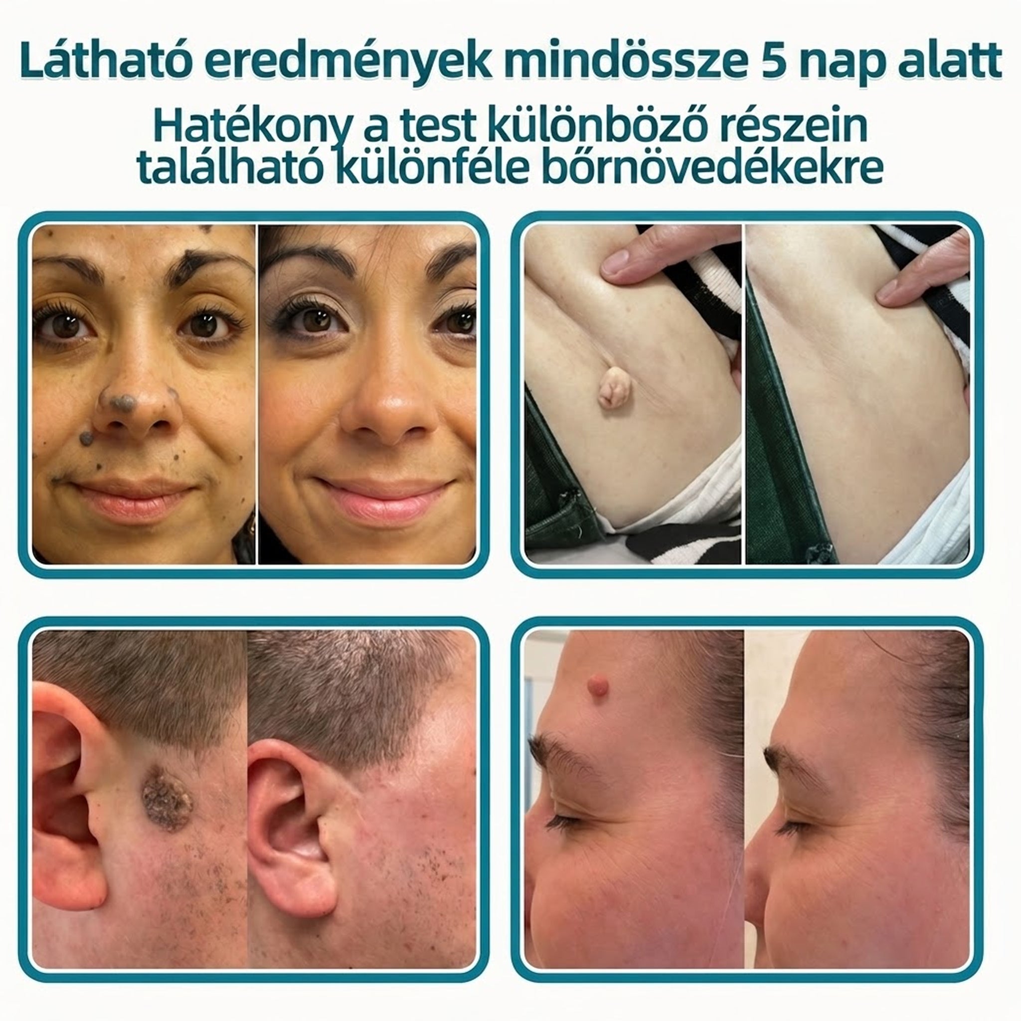 🎉🇭🇺 Healrize® 2 az 1-ben mikrotűs + hidrokolloid tapasz 🤩| Anyajegy, pattanás, lapos szemölcs és bőrkinövés ápolására | Ráncok, hegek és bőrhibák megjelenésének javítására | Láthatatlan tapasz arcra és testre⭐️