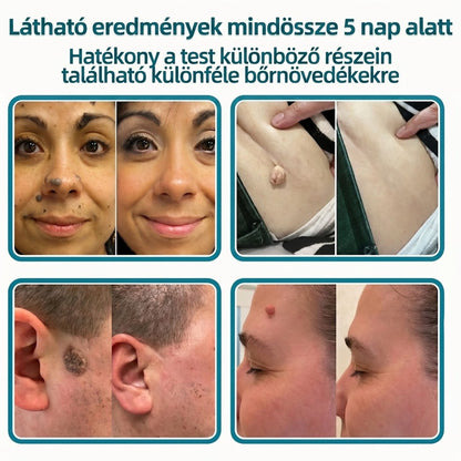 🎉🇭🇺 Healrize® 2 az 1-ben mikrotűs + hidrokolloid tapasz 🤩| Anyajegy, pattanás, lapos szemölcs és bőrkinövés ápolására | Ráncok, hegek és bőrhibák megjelenésének javítására | Láthatatlan tapasz arcra és testre⭐️