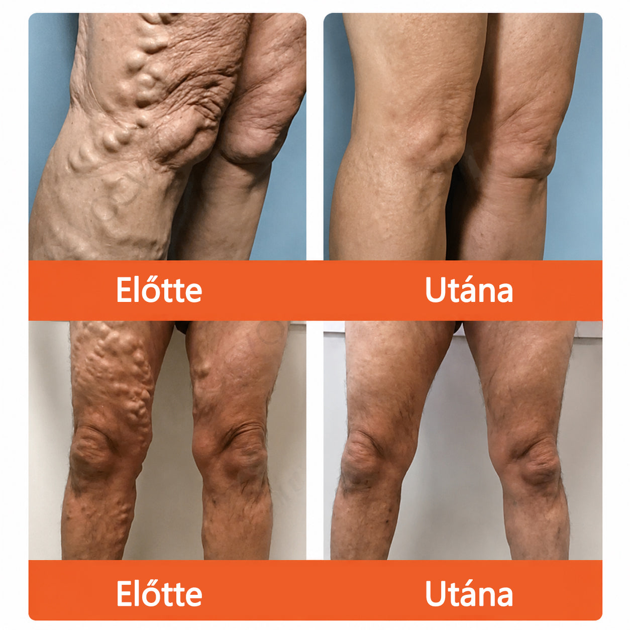 ☘️ Zvoevo® Vein Ease mikro-tűs ápoló tapasz (pókgerincvénák, visszér, duzzanat, fáradt lábak kezelésére)