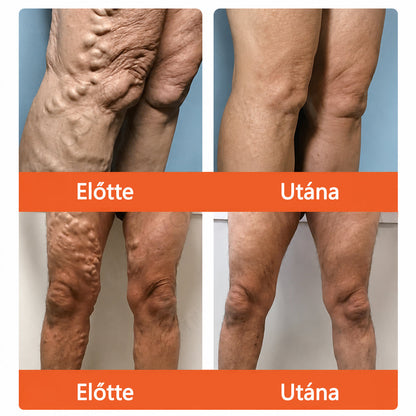 ☘️ Zvoevo® Vein Ease mikro-tűs ápoló tapasz (pókgerincvénák, visszér, duzzanat, fáradt lábak kezelésére)💙