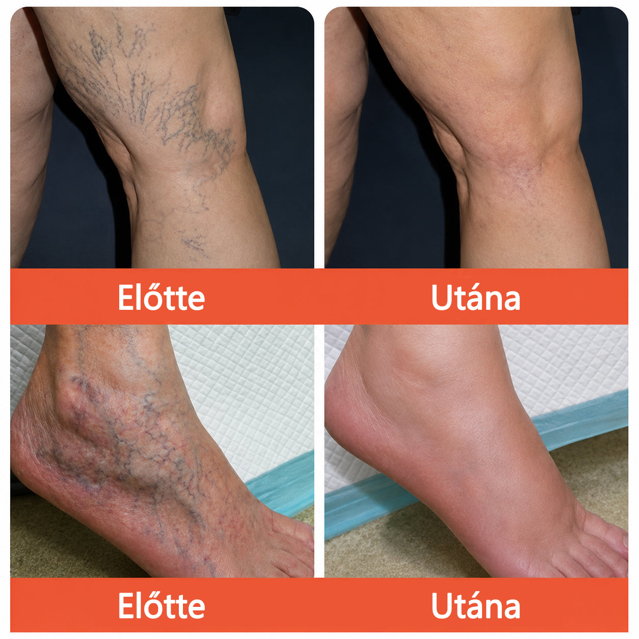 ☘️ Zvoevo® Vein Ease mikro-tűs ápoló tapasz (pókgerincvénák, visszér, duzzanat, fáradt lábak kezelésére)