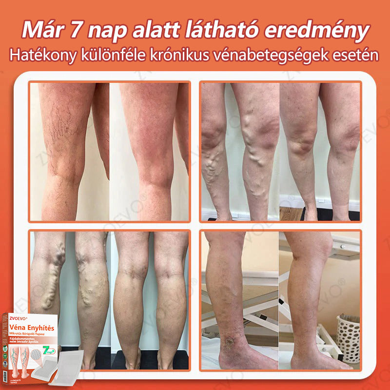 ☘️ Zvoevo® Vein Ease mikro-tűs ápoló tapasz (pókgerincvénák, visszér, duzzanat, fáradt lábak kezelésére)