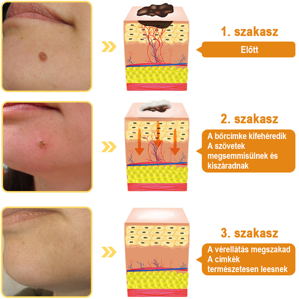🐝🐝Méhméreg szemölcs és övsömör eltávolító spray (👨‍⚕AAD Ajánlott) 🔥(🔥Last Day 80% Off)