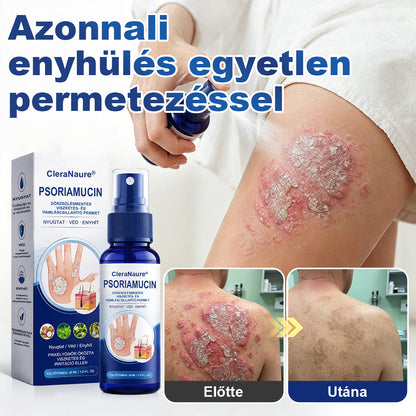 CleraNaure® PsoriaMucin Dörzsölésmentes Viszketés- és Pikkelyenyhítő Permet🎁