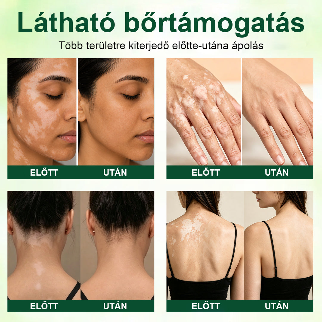 💎CleraNaure® Növényi Vitiligo Krém