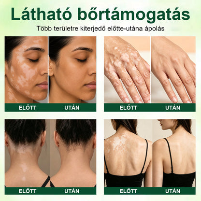 💎CleraNaure® Növényi Vitiligo Krém