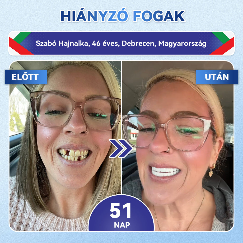 🦷🦷𝐆𝐥𝐢𝐦𝐦𝐞𝐫𝐥𝐲® Tideglusib Fog & íny Javító mikrotűs tapasz | Fejlett őssejt-aktiváló fogcsíkok (újjáépíti a fogzománcot és a dentint • erősíti az ínyt • megszünteti a fogkövet és a szagokat • megállítja a fogérzékenységet)) 3.0