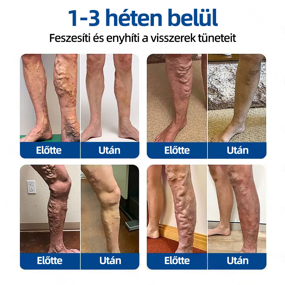 🇭🇺Yutuof® 👩‍⚕️VeinTarget mikrotűs tapasz⚡☑️Azonnali enyhülés hosszú távú eredmények-🔥