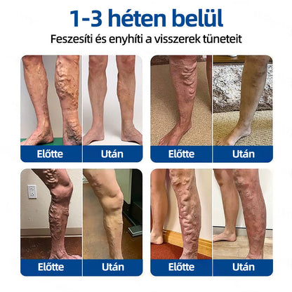 🇭🇺Yutuof® 👩‍⚕️VeinTarget mikrotűs tapasz⚡☑️Azonnali enyhülés hosszú távú eredmények-🔥