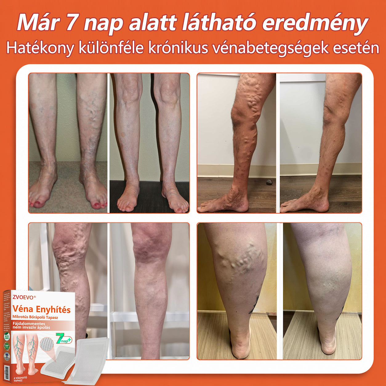 ☘️ Zvoevo® Vein Ease mikro-tűs ápoló tapasz (pókgerincvénák, visszér, duzzanat, fáradt lábak kezelésére)