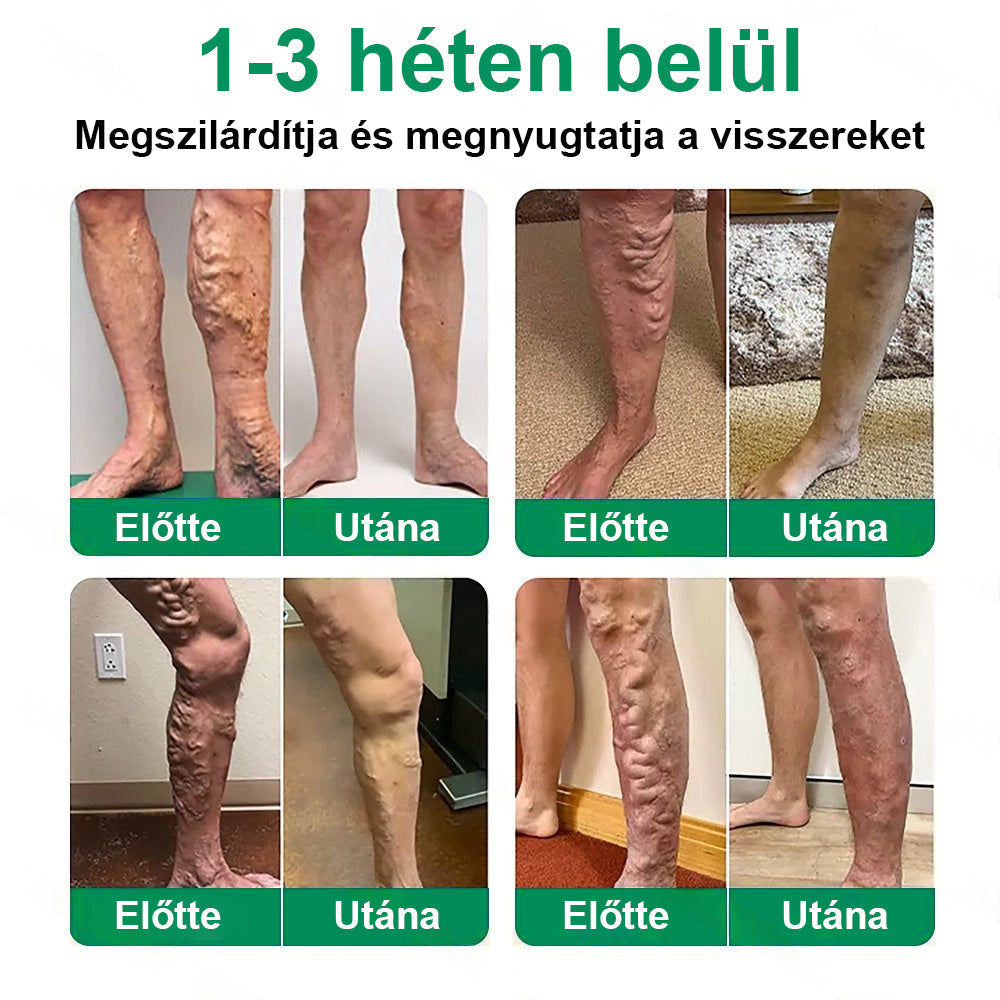 Twisma® VeinTarget – Fejlett mikro tapasz a visszerekre 🔥 96% klinikailag igazolt hatékonyság ⚡ Látható eredmények már 7–14 nap alatt 🌿 Kíméletes támogatás a könnyebb és felszabadult lábakért  🦵