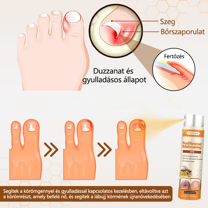 2026🎁 Korlátozott idejű akció 70% kedvezménnyel ️️⏳ Ceoerty® körömgomba spray méhméreggel 💥 2 hét alatt megoldja az összes körömproblémát
