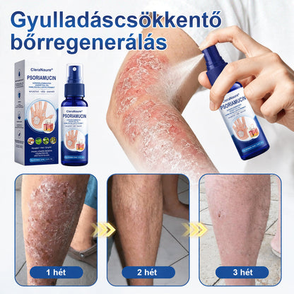 CleraNaure® PsoriaMucin Dörzsölésmentes Viszketés- és Pikkelyenyhítő Permet🎁
