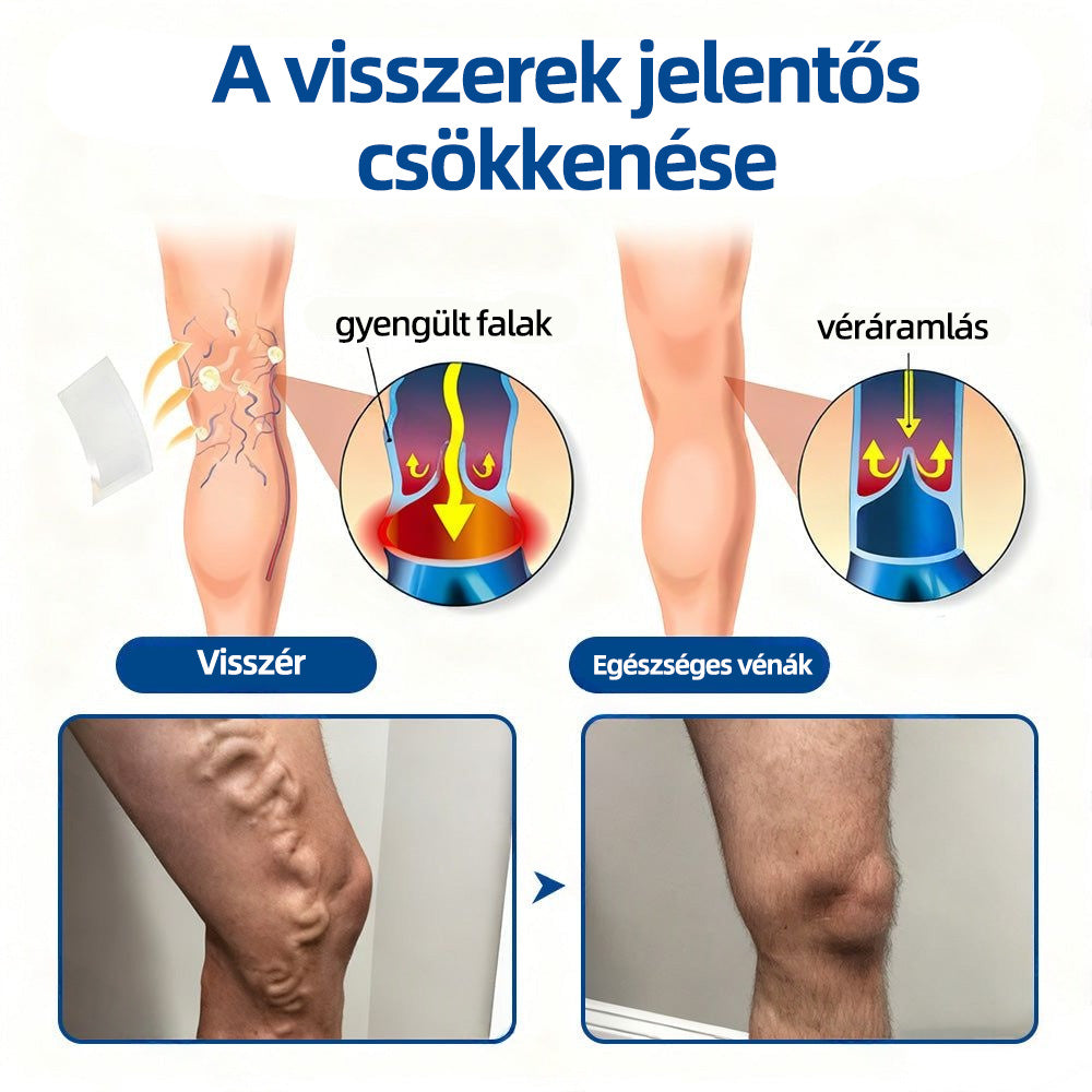 🇭🇺Yutuof® 👩‍⚕️VeinTarget mikrotűs tapasz⚡☑️Azonnali enyhülés hosszú távú eredmények-🔥