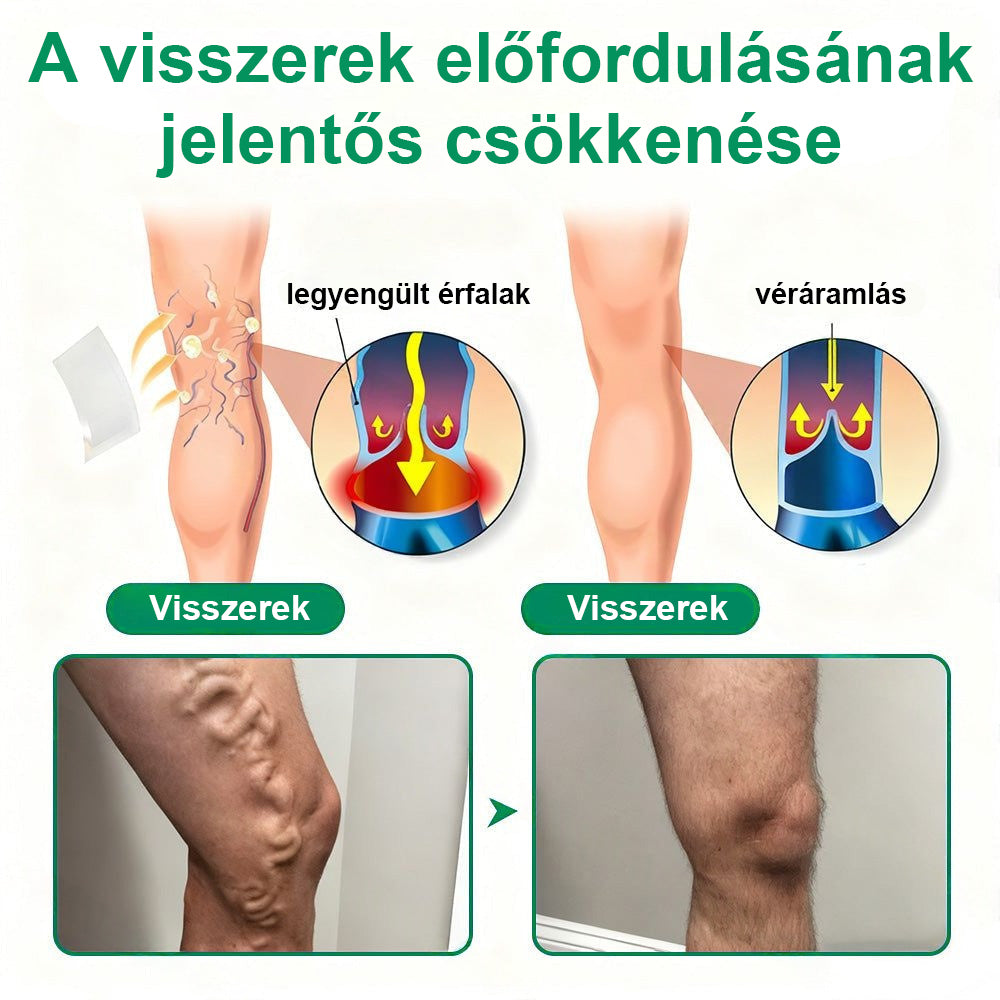 Twisma® VeinTarget – Fejlett mikro tapasz a visszerekre 🔥 96% klinikailag igazolt hatékonyság ⚡ Látható eredmények már 7–14 nap alatt 🌿 Kíméletes támogatás a könnyebb és felszabadult lábakért  🦵