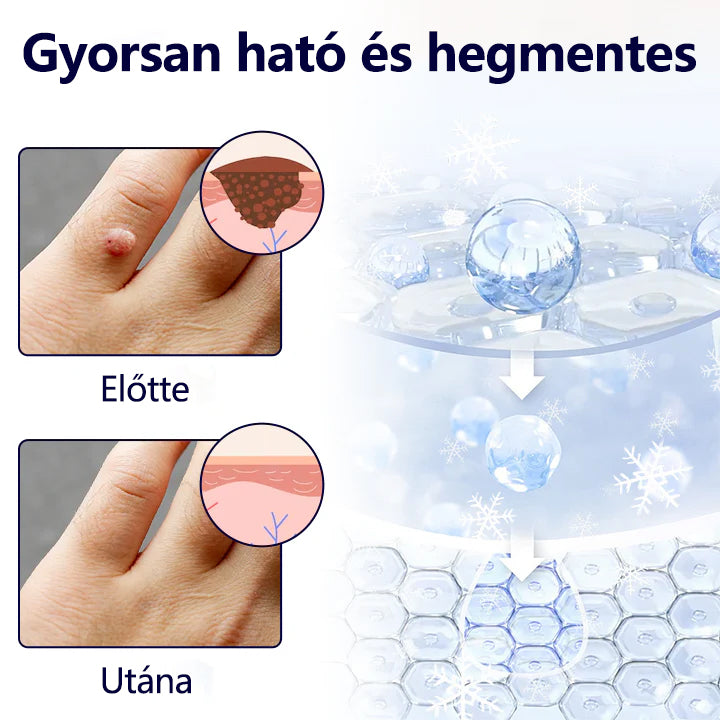 Tivora® WartErase – Fagyasztó Szemölcseltávolító Spray❄️
