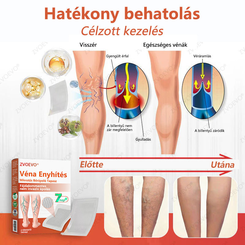 ☘️ Zvoevo® Vein Ease mikro-tűs ápoló tapasz (pókgerincvénák, visszér, duzzanat, fáradt lábak kezelésére)