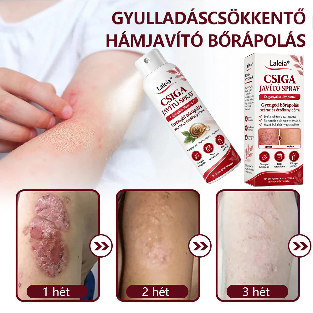 Laleia® Csiganyálka Spray száraz, viszkető és hámló bőr mindennapi ápolására🎁