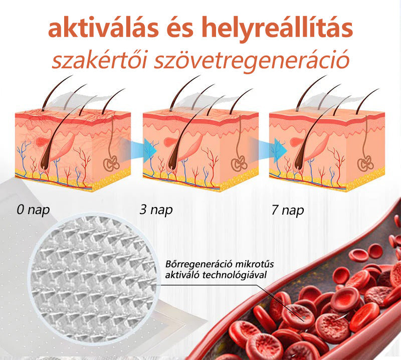☘️ Zvoevo® Vein Ease mikro-tűs ápoló tapasz (pókgerincvénák, visszér, duzzanat, fáradt lábak kezelésére)