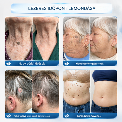 Healrize® 2 az 1-ben mikrotűs hidrogél tapaszok | Eltávolítja a kiemelkedő anyajegyeket, aknét, lapos szemölcsöket és a lágy fibromákat (bőrkinövéseket)🎁