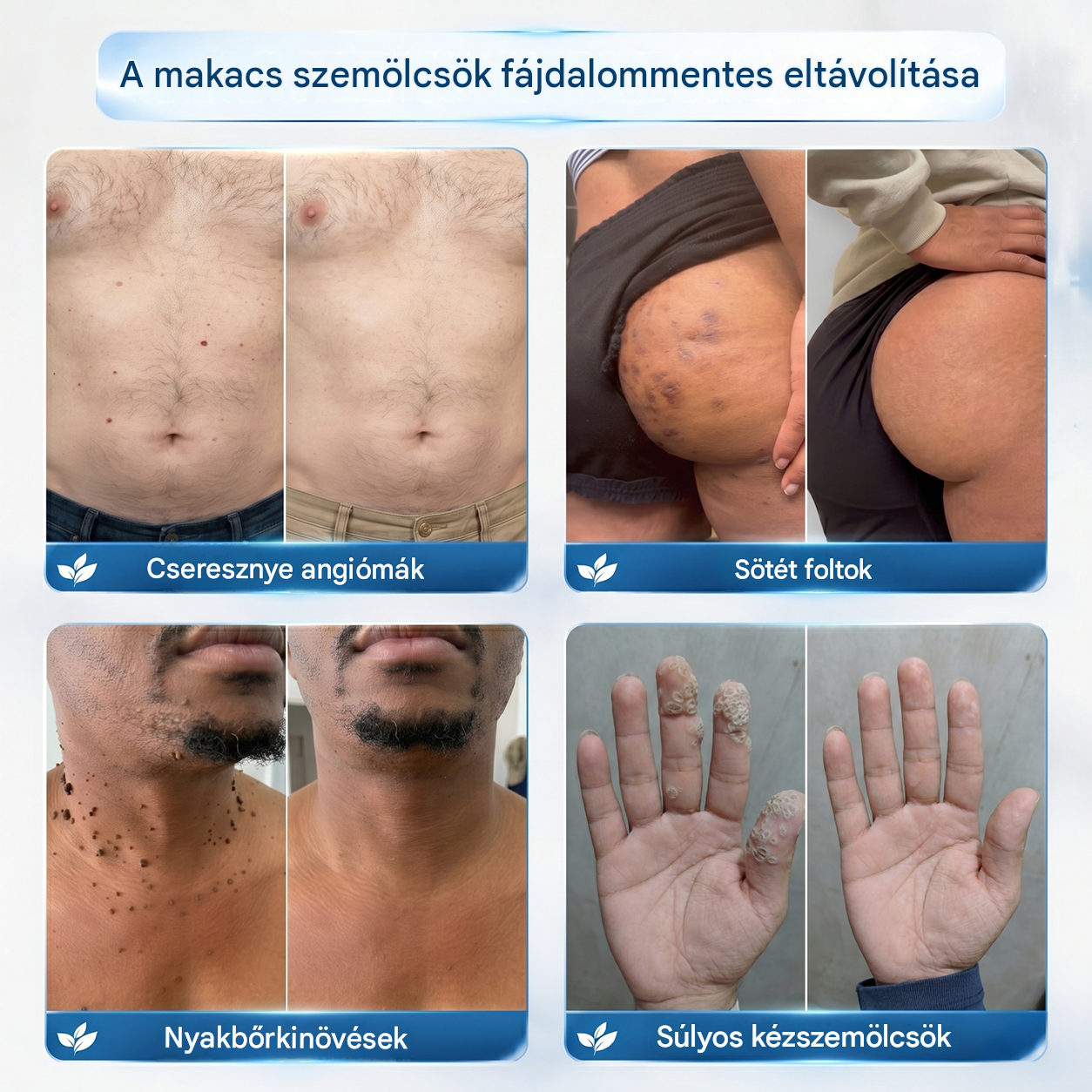 Healrize® 2 az 1-ben mikrotűs hidrogél tapaszok | Eltávolítja a kiemelkedő anyajegyeket, aknét, lapos szemölcsöket és a lágy fibromákat (bőrkinövéseket)🎁