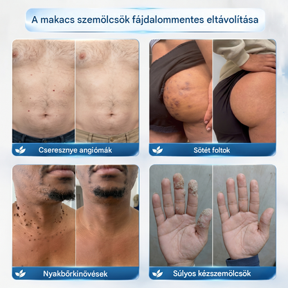 Healrize® 2 az 1-ben mikrotűs hidrogél tapaszok | Eltávolítja a kiemelkedő anyajegyeket, aknét, lapos szemölcsöket és a lágy fibromákat (bőrkinövéseket)🎁