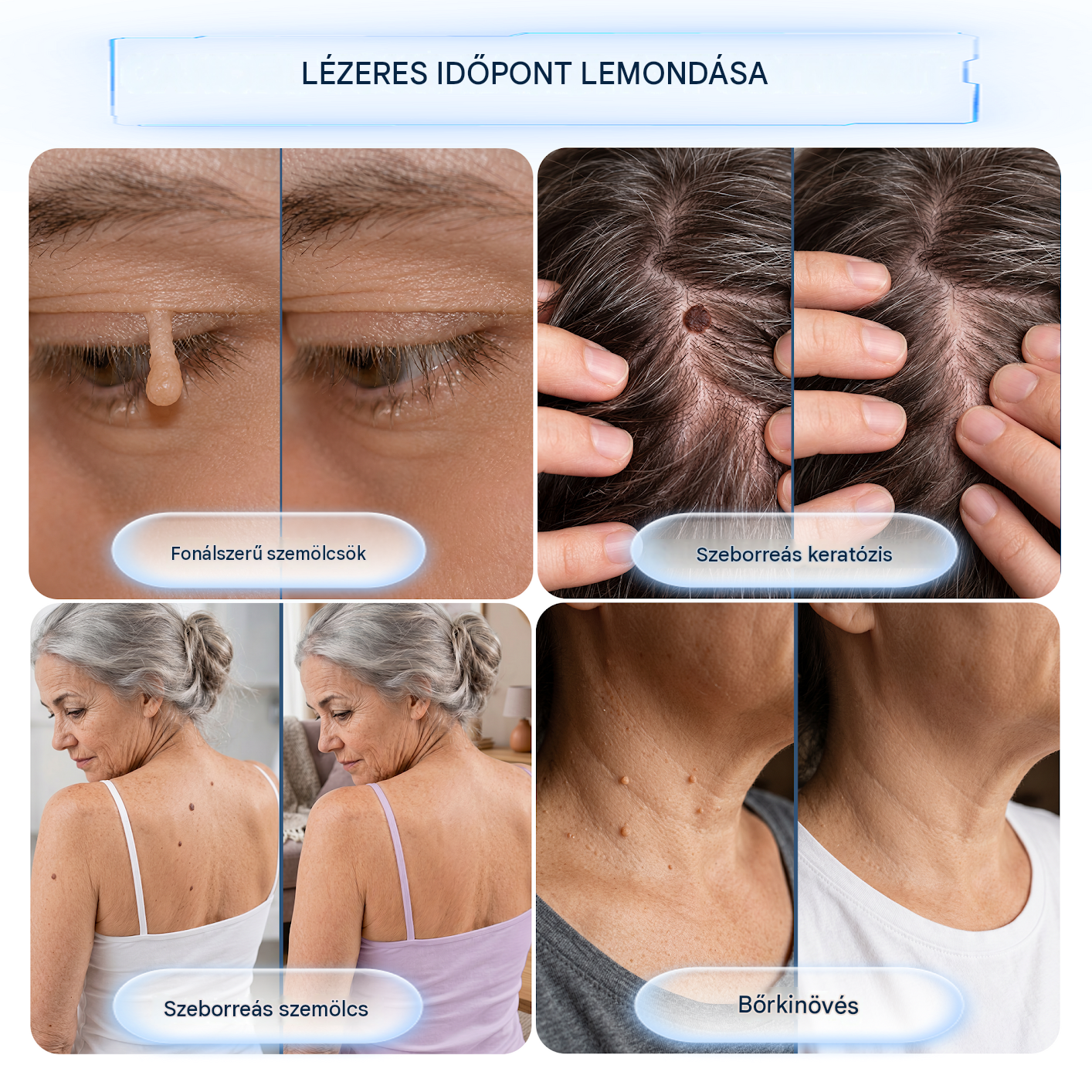 Healrize® 2 az 1-ben mikrotűs hidrogél tapaszok | Eltávolítja a kiemelkedő anyajegyeket, aknét, lapos szemölcsöket és a lágy fibromákat (bőrkinövéseket)🎁